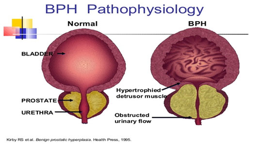 BPH