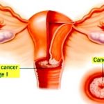 CERVICAL CANCER