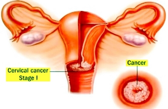 CERVICAL CANCER