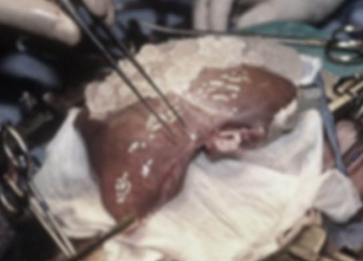 liver transplant