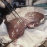 liver transplant